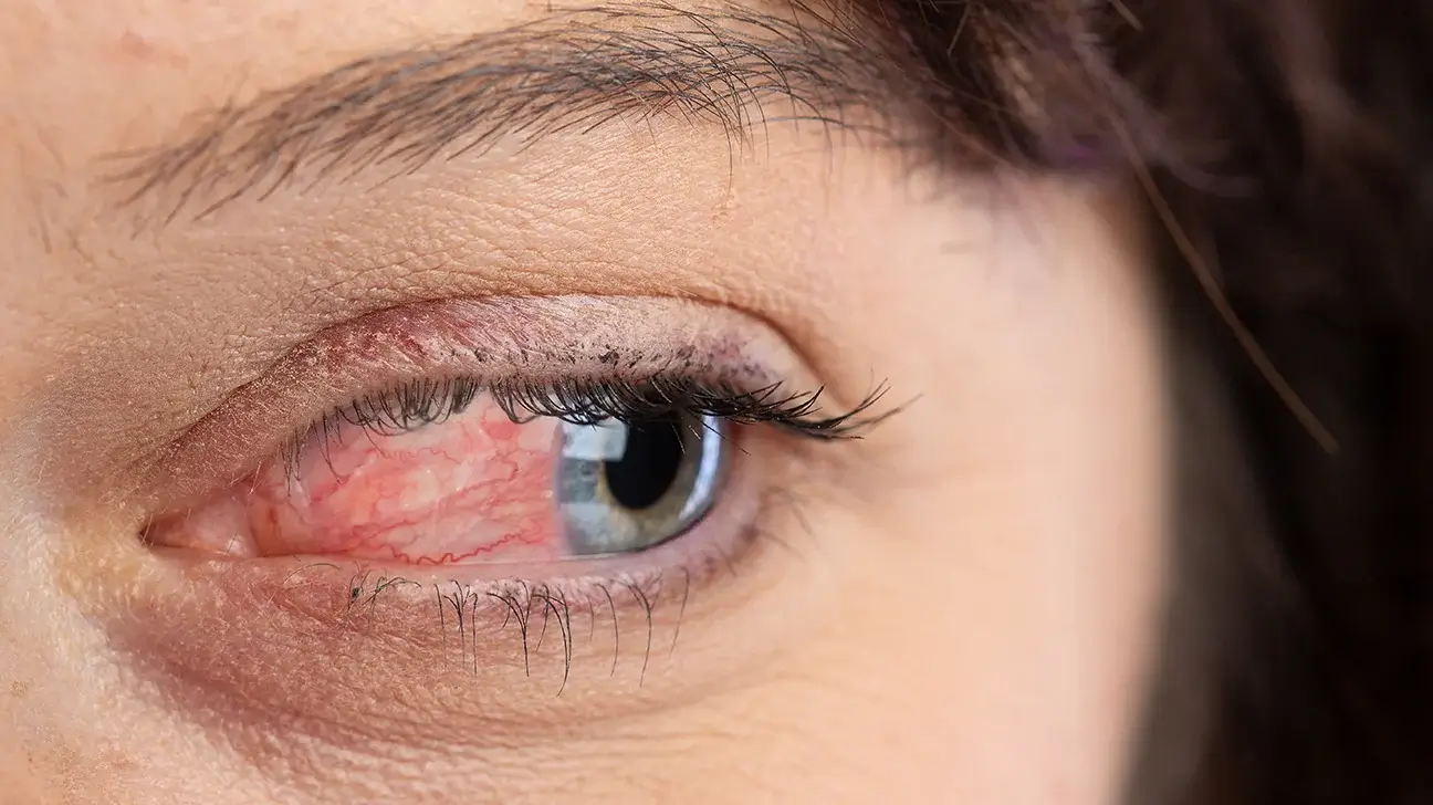 ocular rosacea